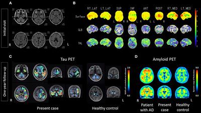 Case report: Non-Alzheimer's disease tauopathy with logopenic variant primary progressive aphasia diagnosed using amyloid and tau PET